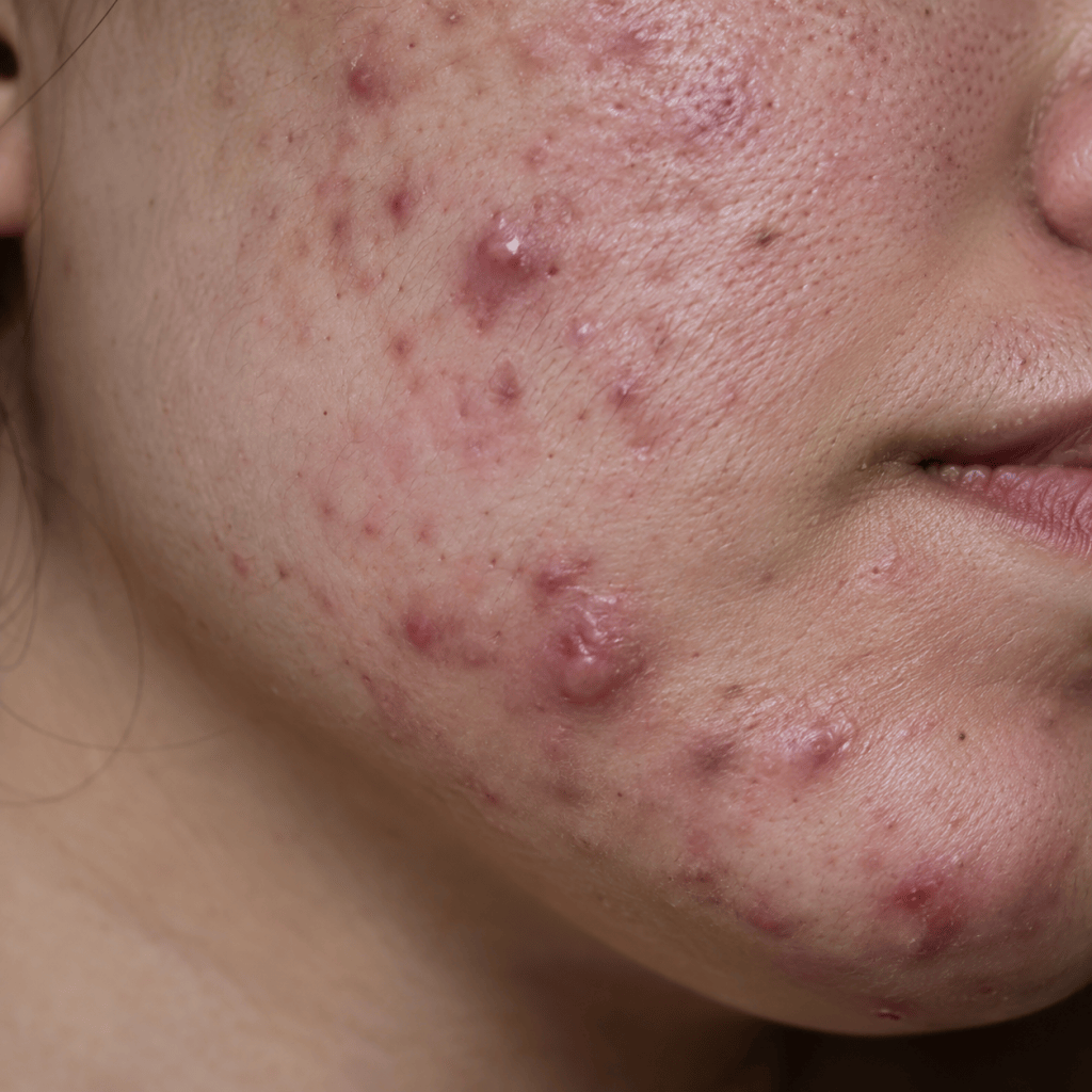 5 Best Cleansers for Cystic & Inflammatory&nbsp;Acne