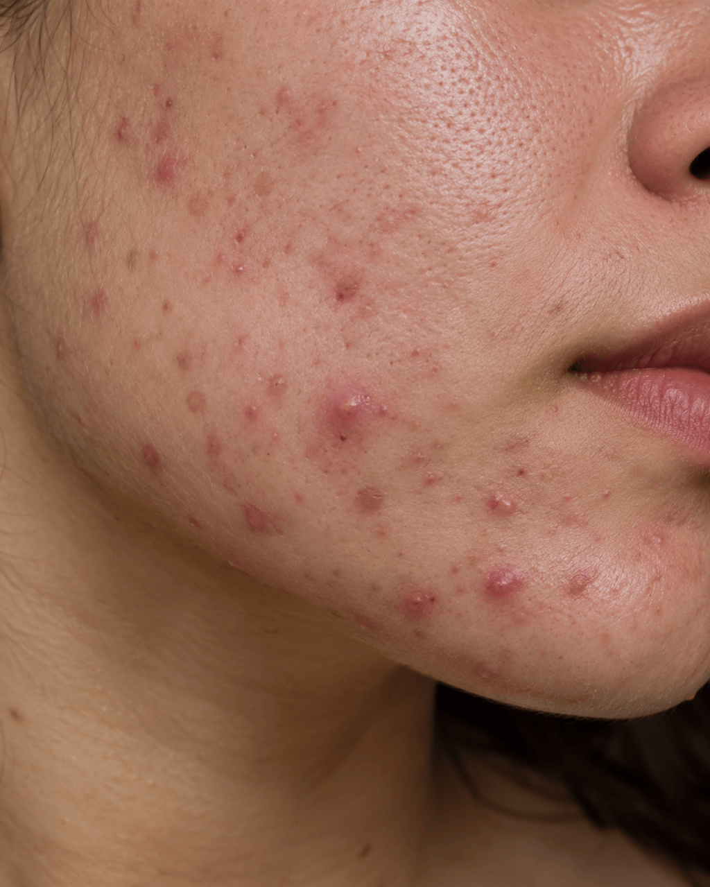 5 Best Cleansers for Acne-Prone & Nodular&nbsp;Acne